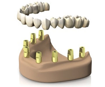Implante dental estética Clinica Portoeuropa Coslada