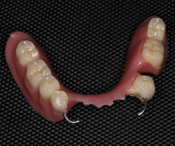Implante dental estética Clinica Portoeuropa Coslada